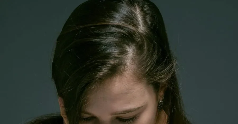 Female-Pattern Baldness: Causes, Symptoms, and Treatments for Women