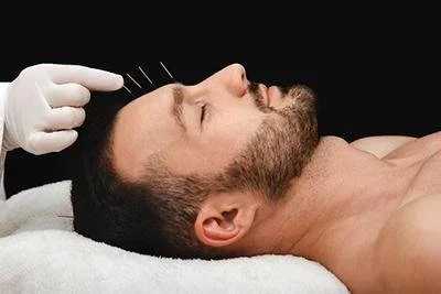 Understanding How Acupuncture Targets Migraine Triggers and Symptoms