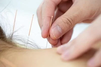 Acupuncture for Neck Pain: A Holistic Approach to Pain Relief