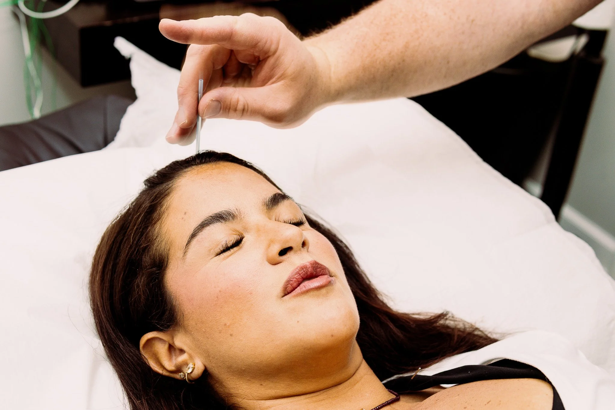 Woman receiving acupuncture treatment while lying in bed with eyes closed