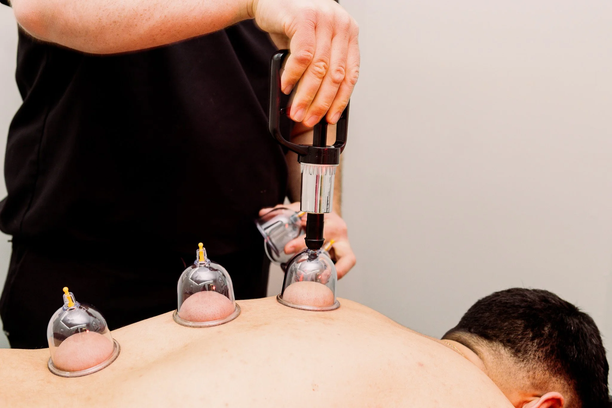 A person performing cupping therapy on a back, using a suction device to create negative pressure in glass cups placed on the skin.