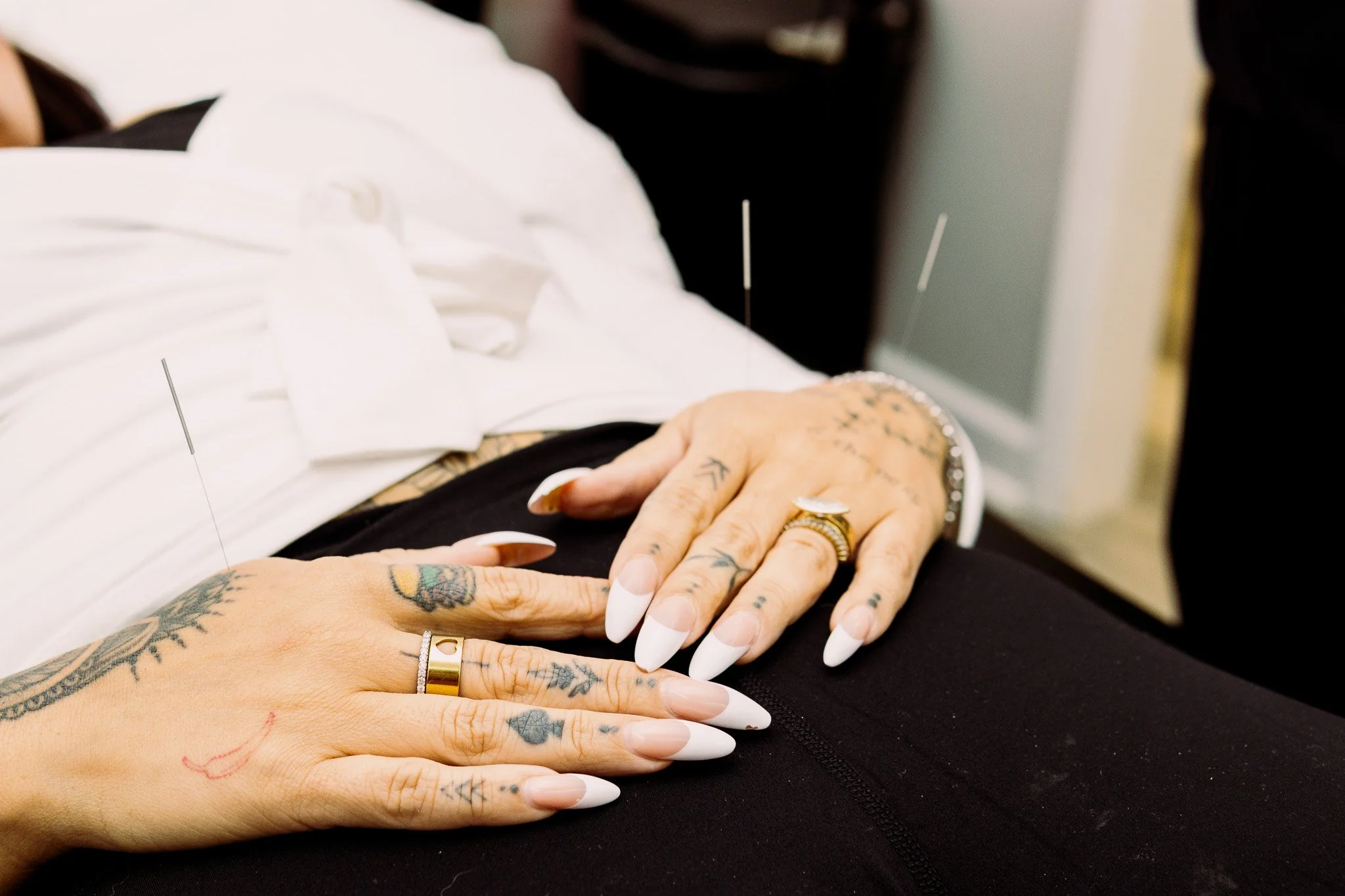 Tattooed hands with rings resting on a person's lap, with acupuncture needles inserted into the abdomen.