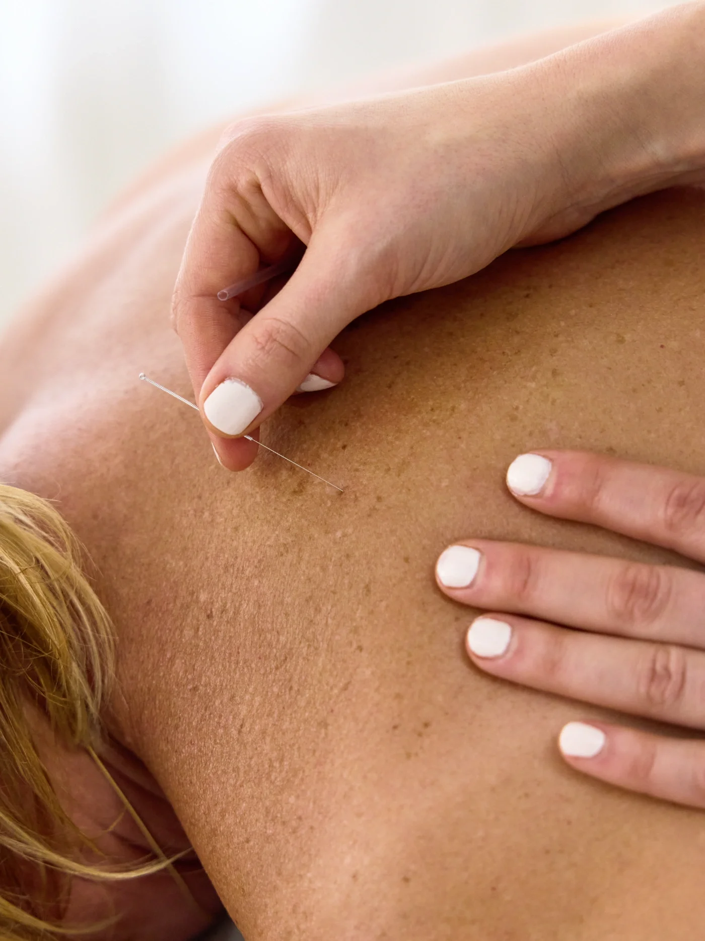 Dr. Ashley Taylor, ND, RMT, performing acupuncture on a person's back with a fine needle in Guelph, Ontario