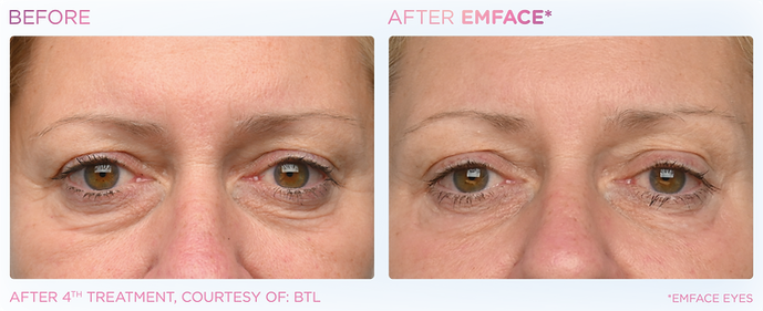 emface before-after simplicity medspa (9).png