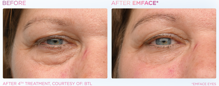 emface before-after simplicity medspa (8).png