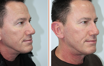 emface before-after simplicity medspa (7).png