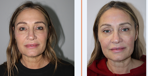 emface before-after simplicity medspa (6).png