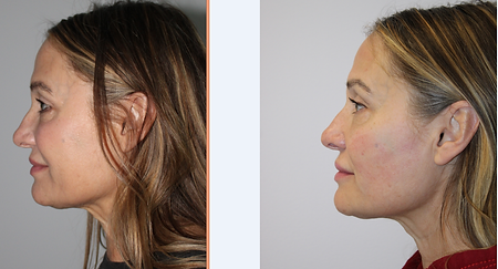 emface before-after simplicity medspa (5).png