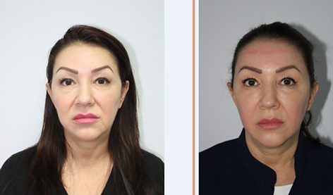 emface before-after simplicity medspa (4).png
