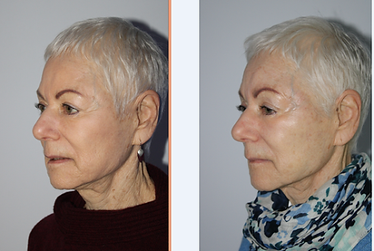 emface before-after simplicity medspa (3).png