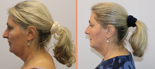 emface before-after simplicity medspa (2).png