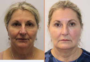 emface before-after simplicity medspa.png