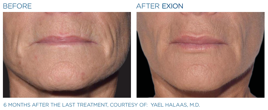 Exion_PIC_Ba-card-mouth-female-066_FRF_ENUS100.png