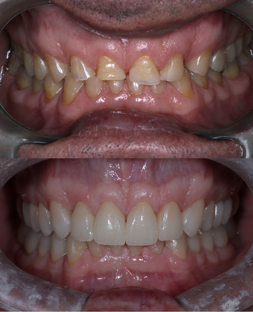 Bruxismo: por que o tratamento não pode focar só nos dentes