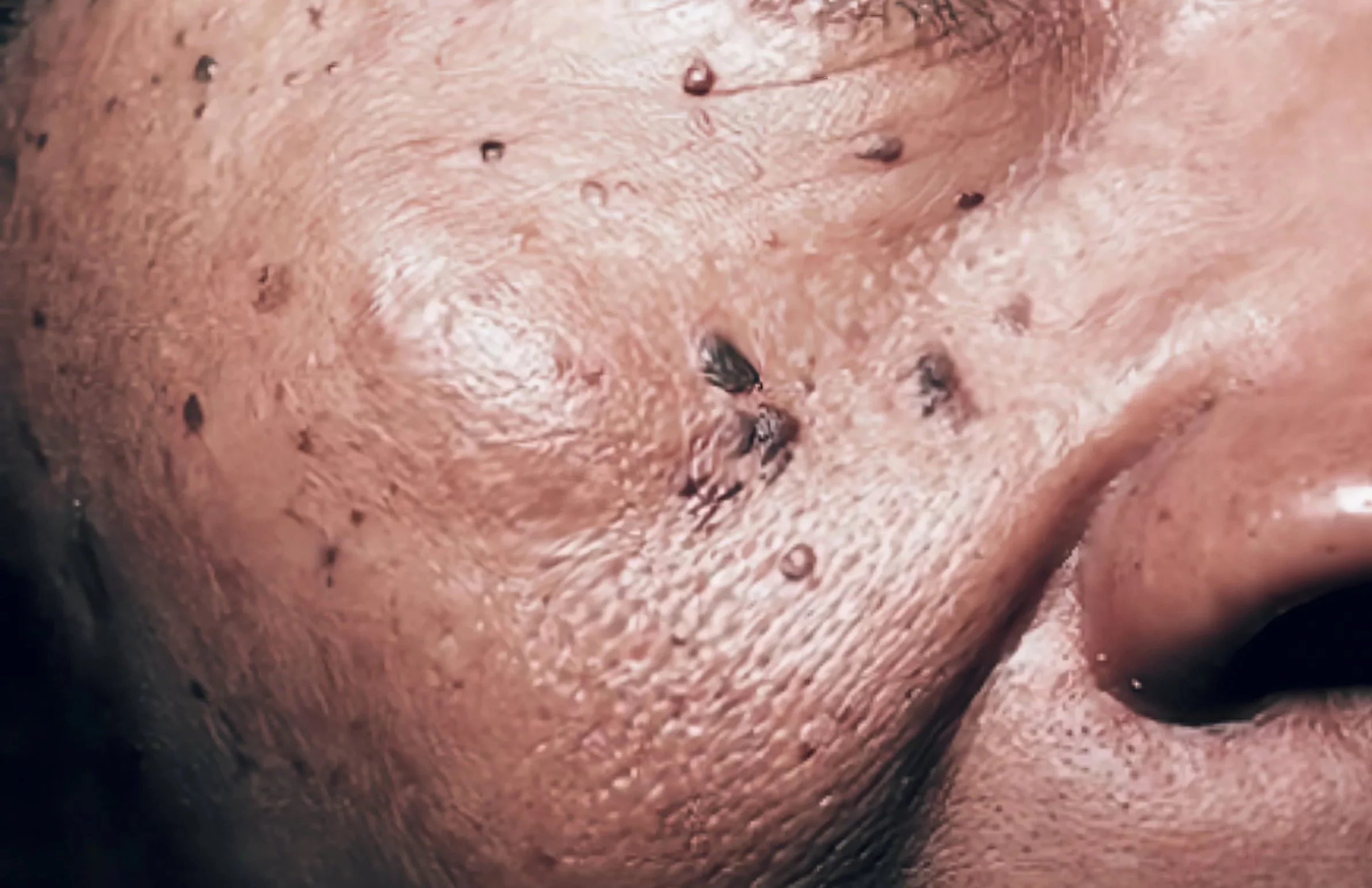 Dermatose papulosa negra