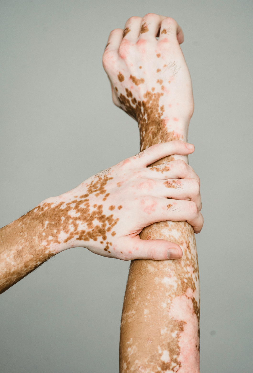 Duas mãos com manchas de vitiligo segurando um braço também com manchas de vitiligo.