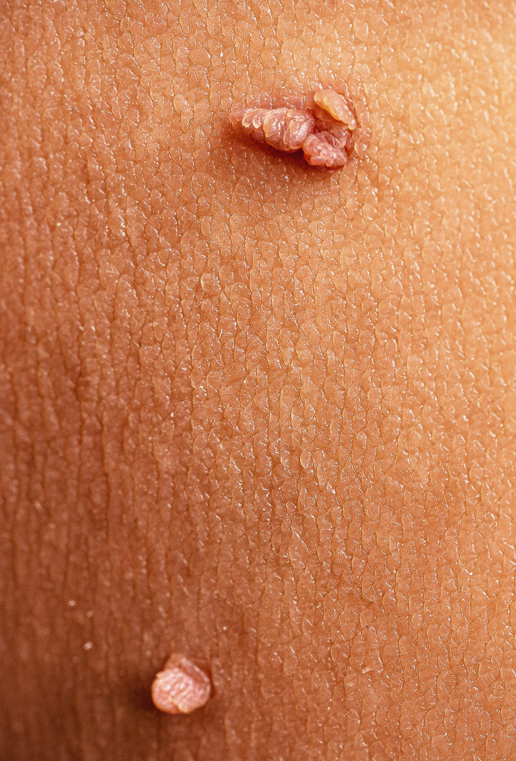 Acrocordon - Fibroma mole - FERNANDO+HENRIQUE+CANHOTO+ALVES+Cirurgia Dermatológica - Dermatologic Surgery