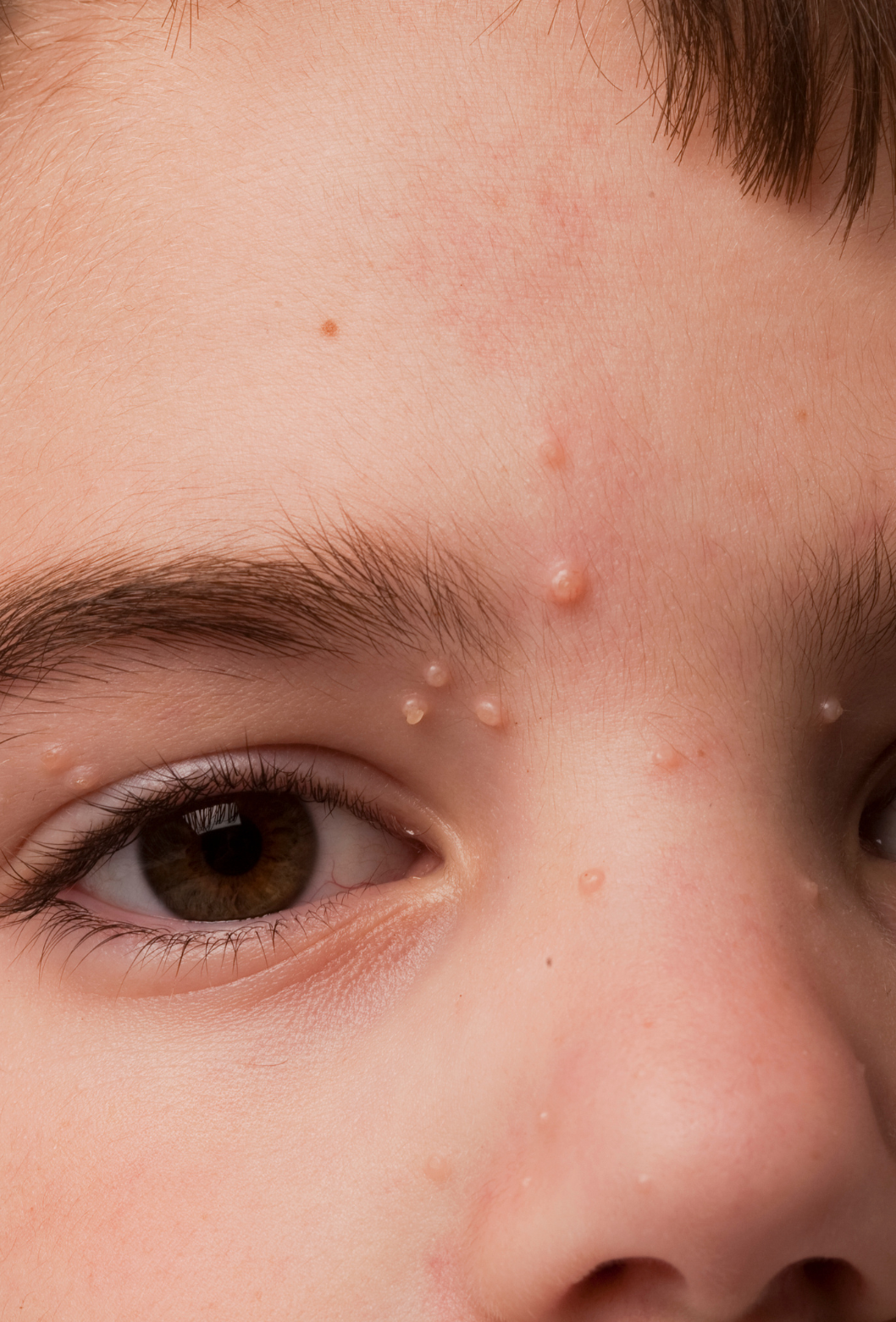 Close-up da testa de uma criança, mostrando sobrancelhas, olhos e região do nariz, com várias verrugas na testa e ao redor das sobrancelhas.