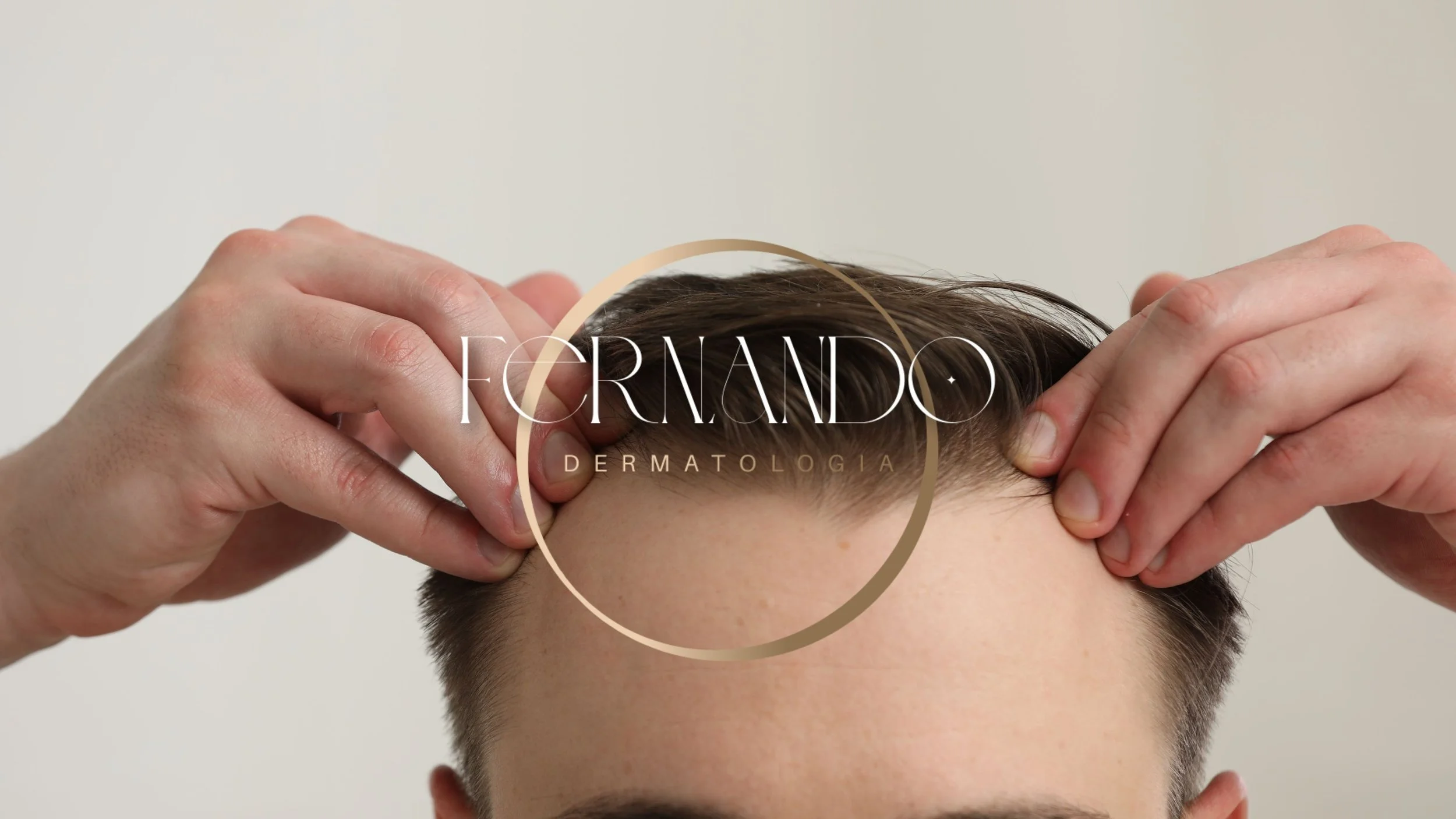 Alopecia Androgenética Masculina: Entenda as causas, o diagnóstico e as opções de tratamento