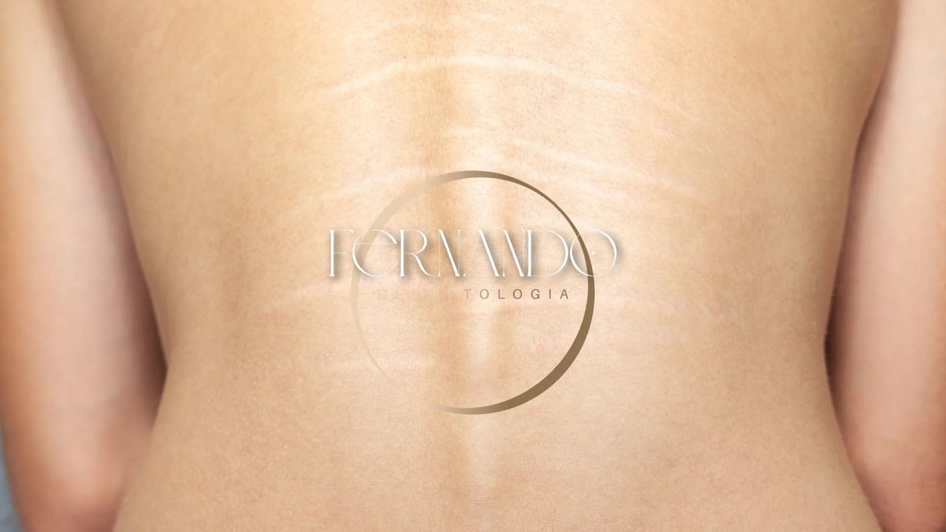 dorso de uma mulher com estrias do crescimento