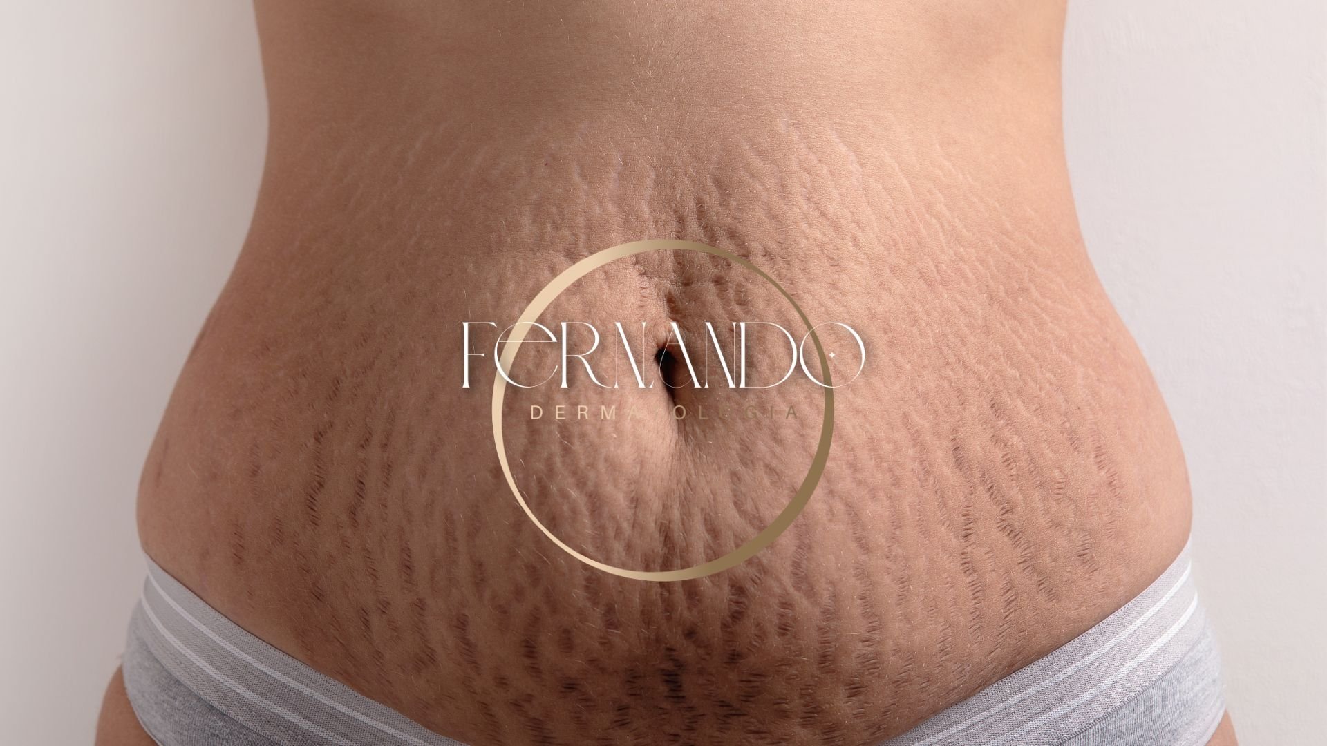 Abdomen de mãe de filho com a apresentando estrias rubras no abdomen irei