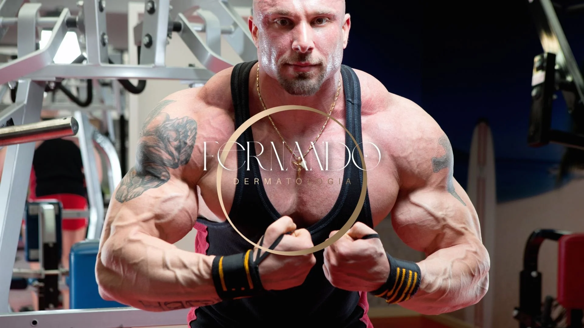 Fisioculturista com maior de risco de evoluir com estrias nos braço e coxas devido estiramento da derme