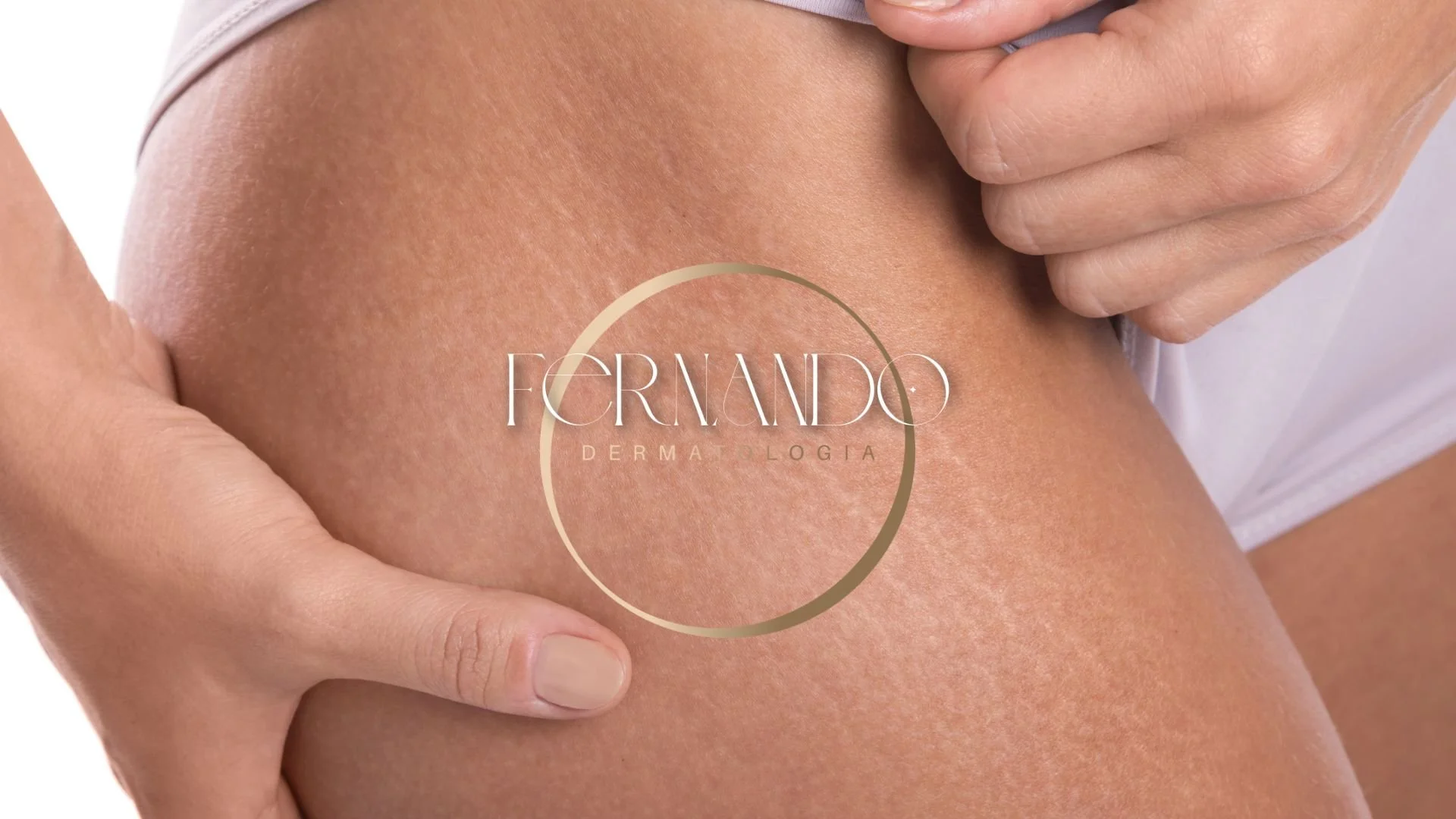 Corpo em Dia: Tudo o que você precisa saber para vencer as estrias (e as novidades para 2026!)