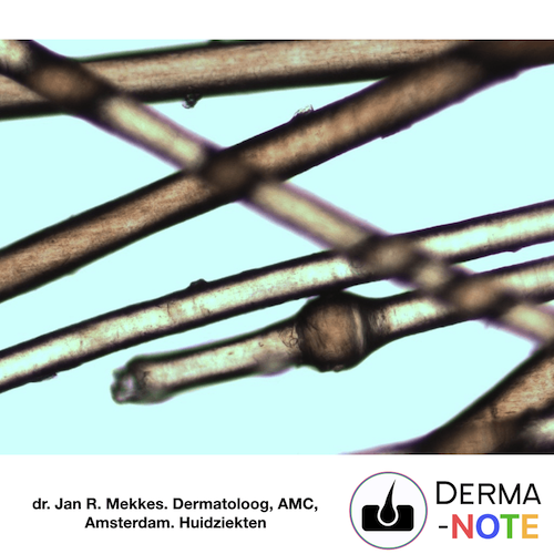 Cabelos e unhas Dermanote - tricorrexe invaginata - Netherton Syndrome