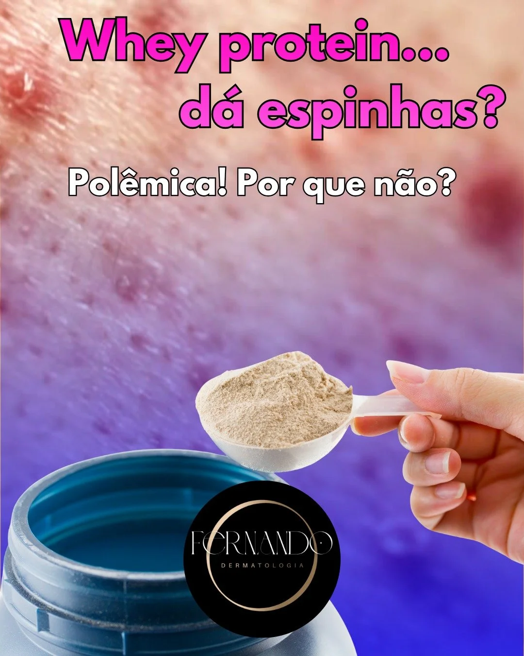 &ldquo;Todo mundo na academia toma whey protein, s&oacute; eu tenho espinha&rdquo;.. O Whey n&atilde;o d&aacute; espinha, quem tem espinha &eacute; voc&ecirc; que: 

1- tem tend&ecirc;ncia a desenvolver acne;

2- T&aacute; tomando bomba e culpa o whe