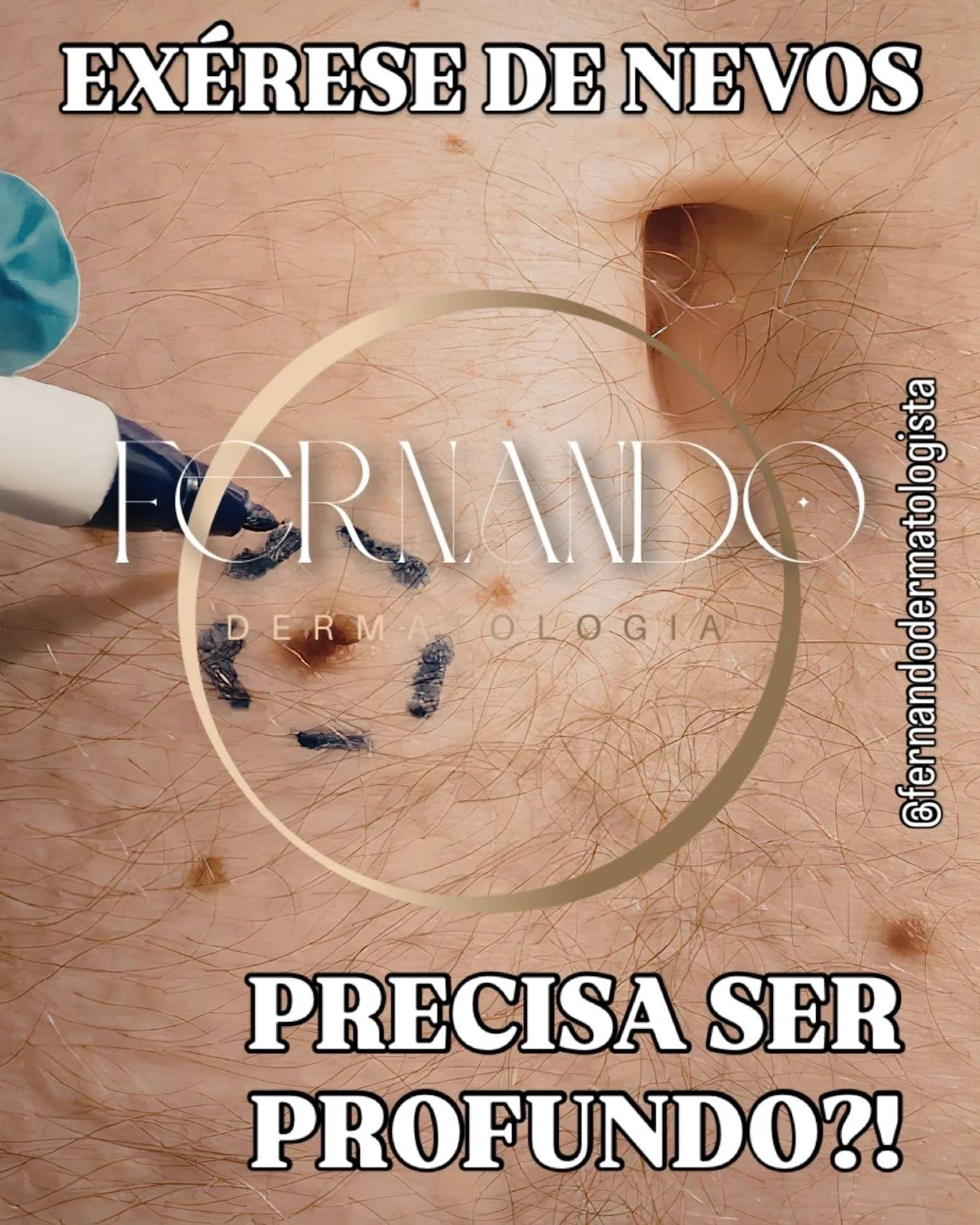 Sabe aquela &ldquo;pintinha&rdquo; (nevo) que mudou de cor, cresceu ou simplesmente incomoda no espelho? A remo&ccedil;&atilde;o cir&uacute;rgica, ou ex&eacute;rese, &eacute; o caminho mais seguro e eficaz para tratar essas les&otilde;es.

Muitas pes