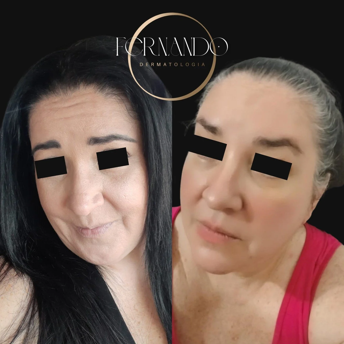 ✨Mudar o olhar muda tudo. ✨

Sabe aquela express&atilde;o de cansa&ccedil;o ou preocupa&ccedil;&atilde;o que insiste em aparecer, mesmo quando estamos felizes? O poder do Dysport n&atilde;o est&aacute; em "mudar" quem voc&ecirc; &eacute;, m