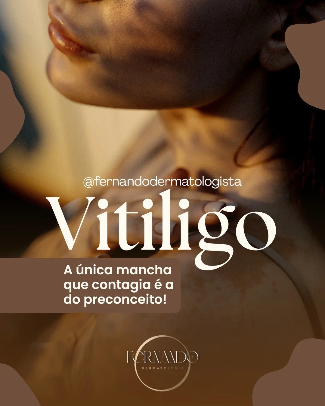 🤍 Pele &eacute; hist&oacute;ria, n&atilde;o &eacute; defeito.🖤

Muita gente olha para o vitiligo e foca apenas nas manchas, mas esquece de olhar para a pessoa. Se existe algo que realmente n&atilde;o ajuda em nenhum tratamento, &eacute; o julgament