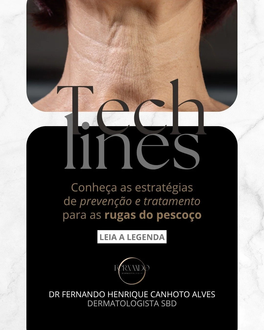 O tratamento do "tech neck" &mdash; as rugas e a flacidez na regi&atilde;o do pesco&ccedil;o causadas pelo uso excessivo de dispositivos m&oacute;veis &mdash; exige uma abordagem t&eacute;cnica e personalizada.

A pele desta &aacute;rea &ea