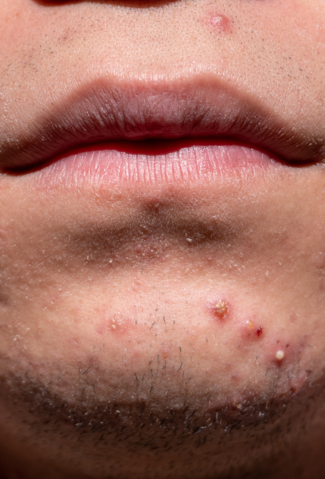 Close-up de lábios, queixo e região ao redor, com várias espinhas e manchas.