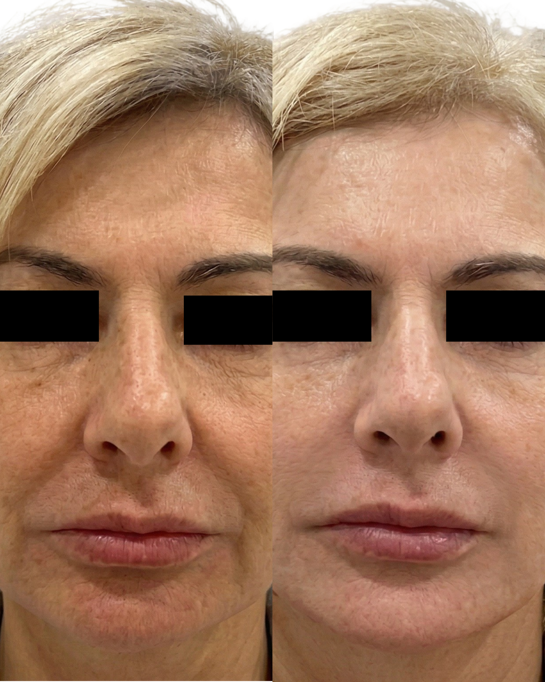 Comparação de duas imagens do rosto de uma mulher, mostrando uma melhora na textura da pele, especialmente na região da testa, sobrancelhas e lábios, possivelmente após um procedimento de estética ou tratamento de pele.