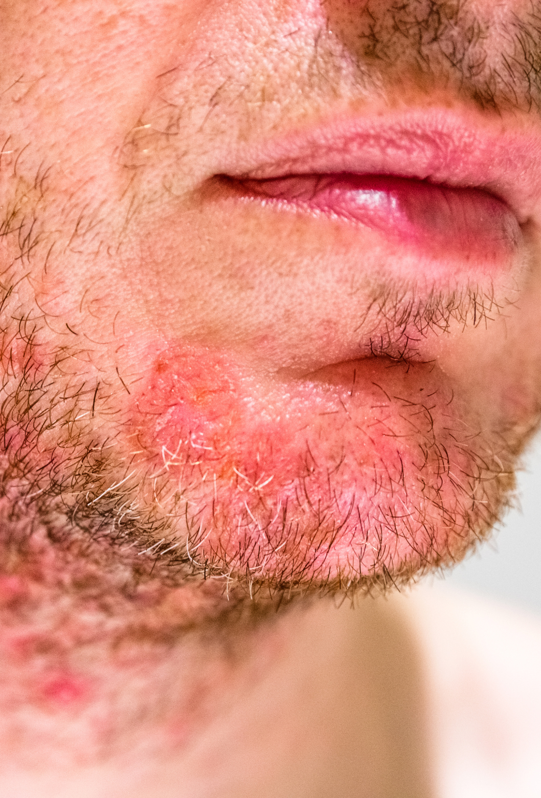 Close-up de barba e lábios de um homem, com destaque para área do queixo com irritação e uma pequena ferida ou afta.