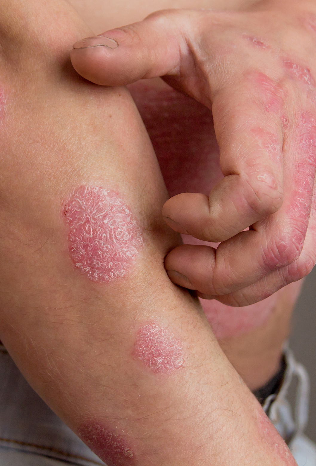 Casca de psoríase na pele, com manchas vermelhas escamosas e inflamação.