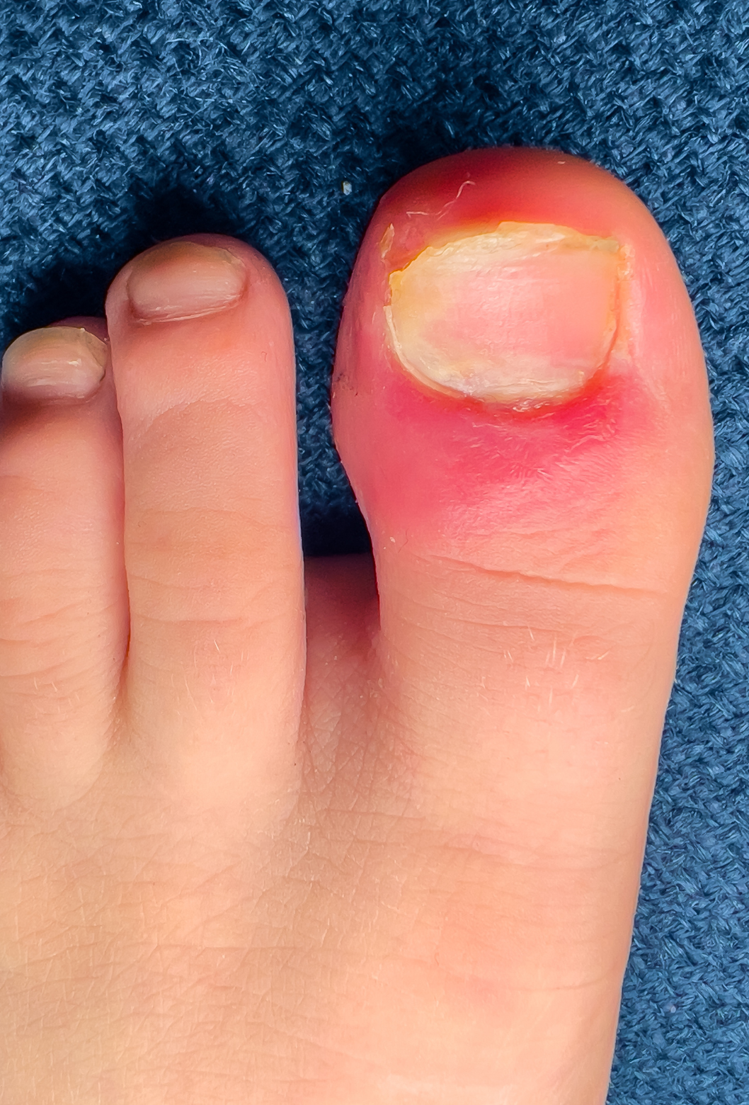 Dedos de mãos com unhas pintadas e unhas danificadas, exibindo levantamento de esmalte e possível ferida ou irritação na cutícula do dedo polegar, sobre uma superfície azul de tecido.