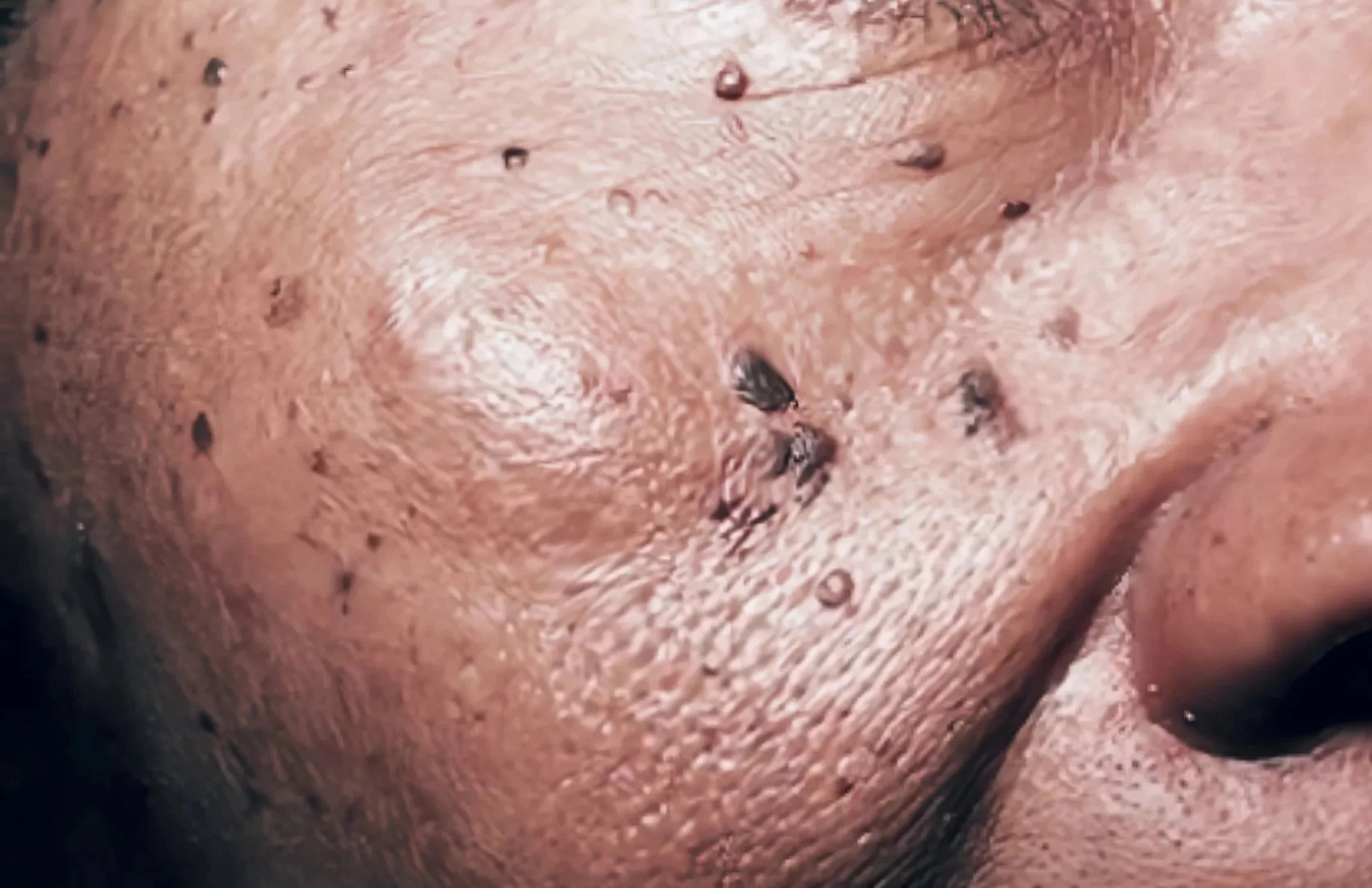 Imagem de uma pele com pêlos e manchas escuras, possivelmente acne ou cicatrizes.