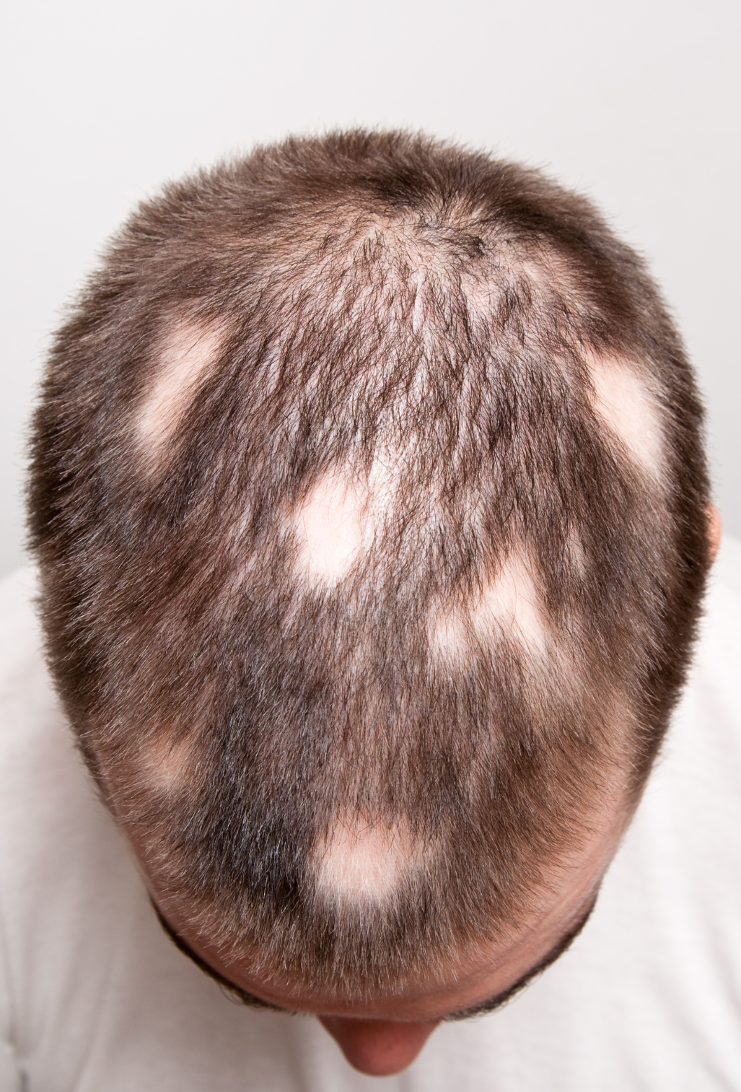 Topo de cabeça masculina com áreas de calvície e manchas de pêlos na parte superior e frontal.
