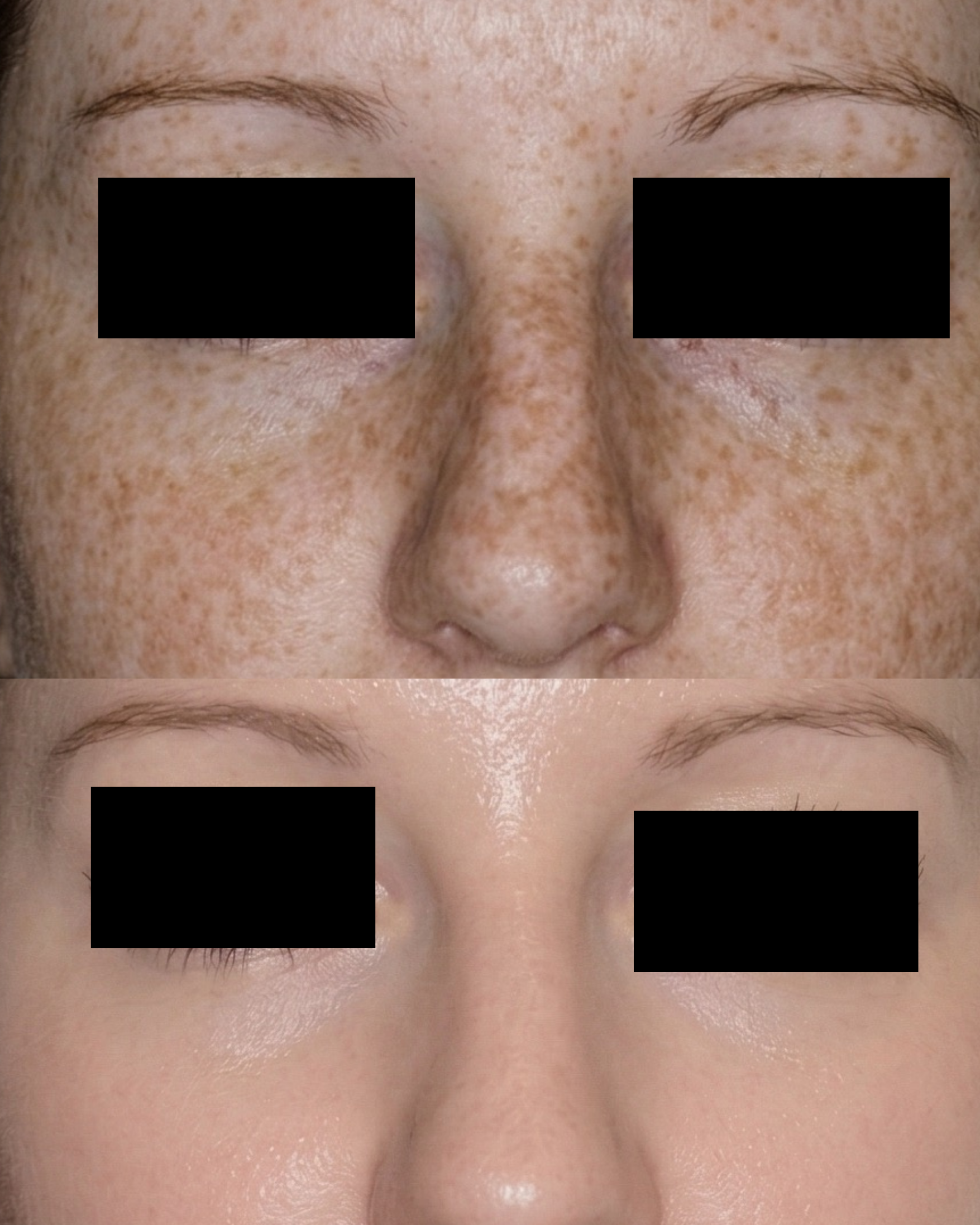 Imagem com duas fotos comparativas de uma pessoa, demonstrando a mudança na pele do rosto antes e depois de um tratamento. A parte superior mostra a pele com manchas de sol e textura irregular, enquanto a parte inferior mostra a pele mais clara, uniforme e com menos manchas.