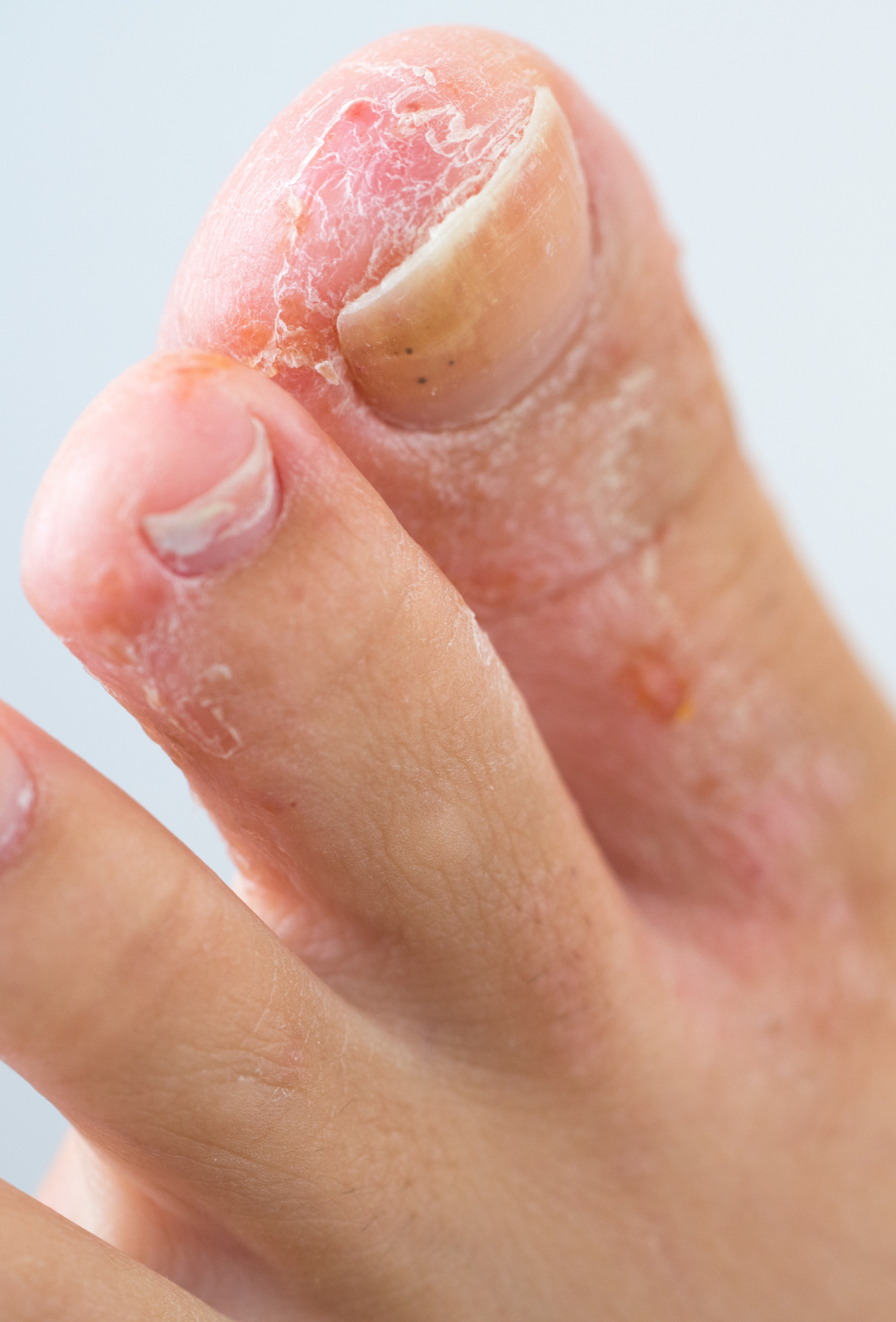Dedo com unhas parcialmente roída e pele seca, com sinais de descamação.