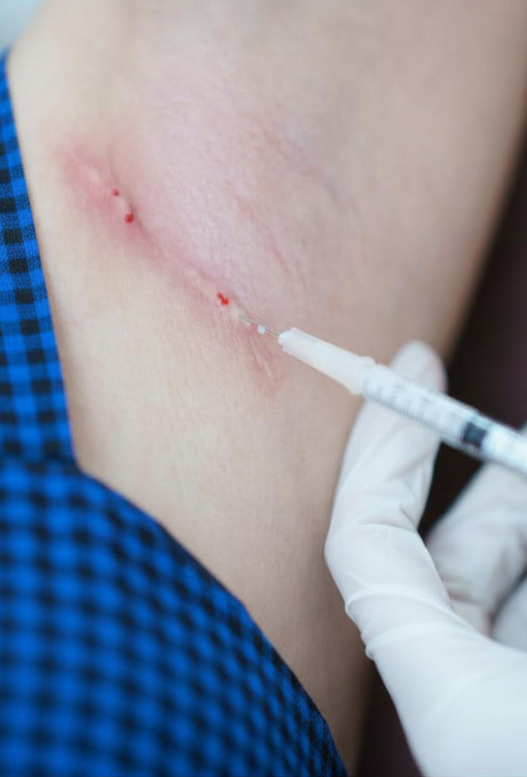 Pessoa recebendo uma injeção na altura do braço com uma seringa por um profissional com luva.