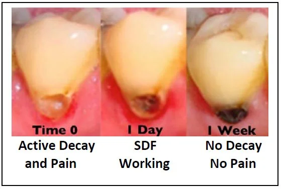 SDF treated cavity example turning dark