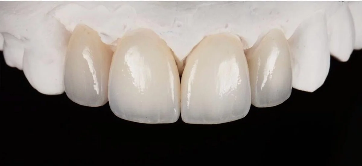 Close-up of a set of upper front teeth with dental crowns on a dental model.