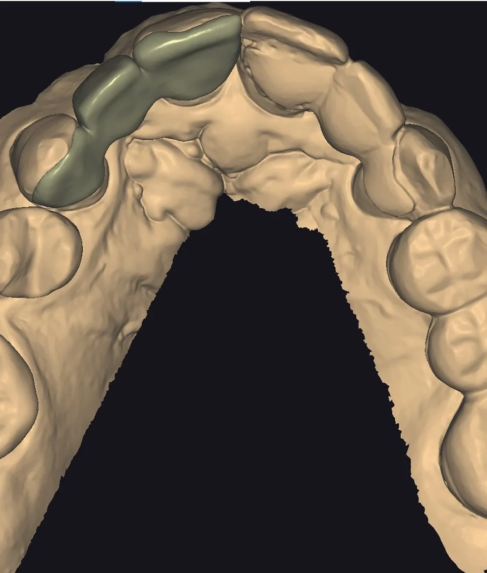 3D digital model of a human dental arch with a highlighted section on the upper left side, possibly indicating a dental restoration or area of interest.