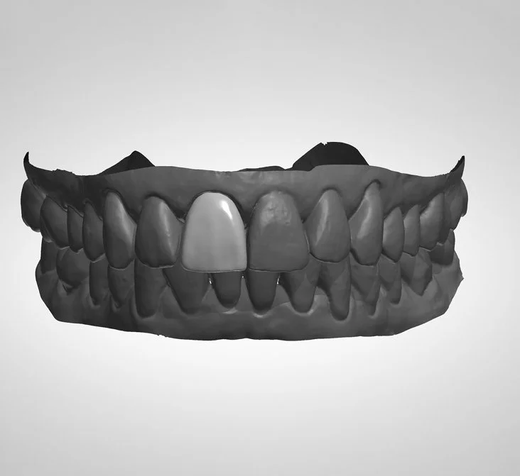 A 3D model of a set of human teeth, showing both upper and lower jaws with some irregular and missing teeth.