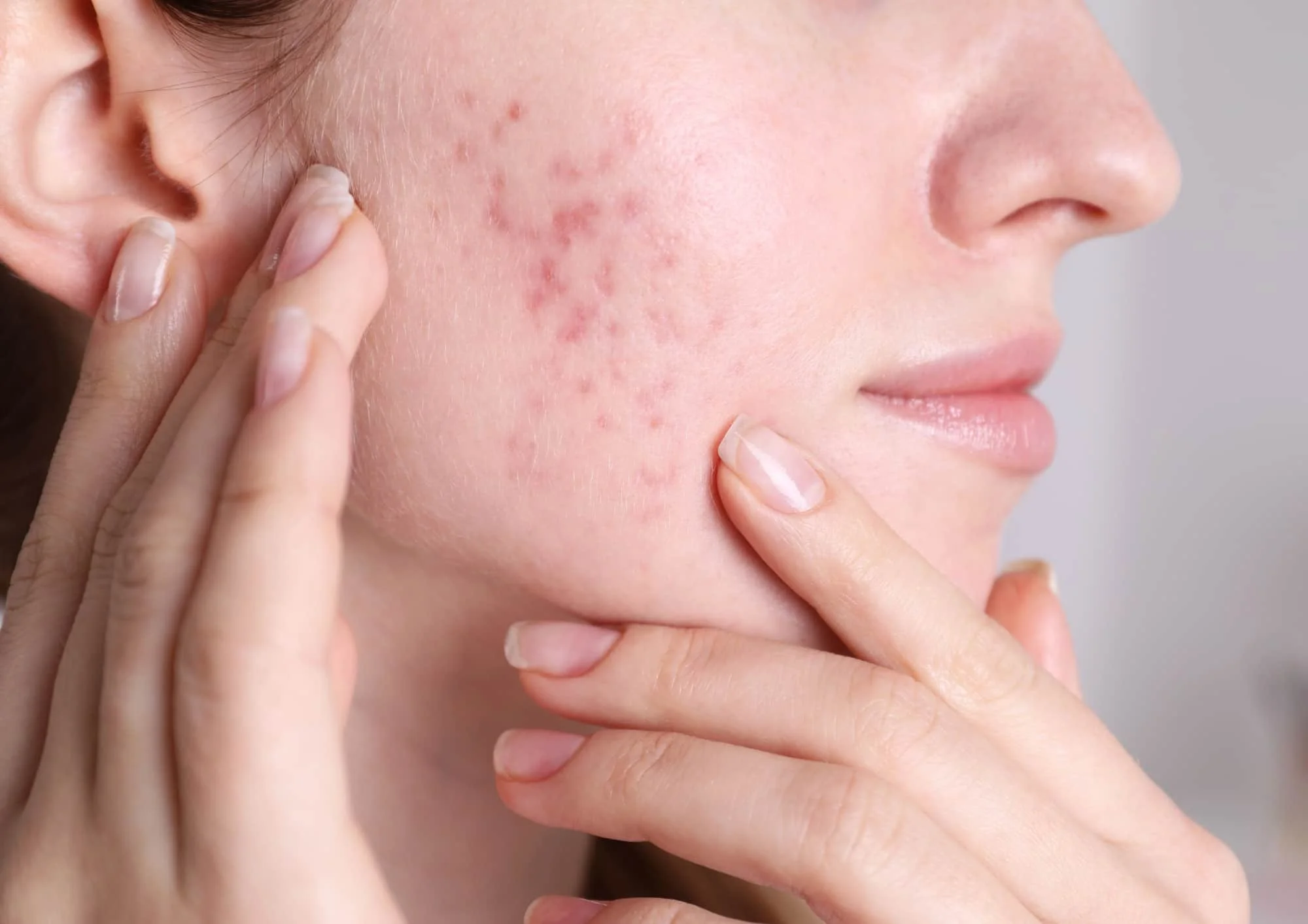 Rosacea und Rötungen – wie der Stoffwechsel das Hautbild beeinflusst