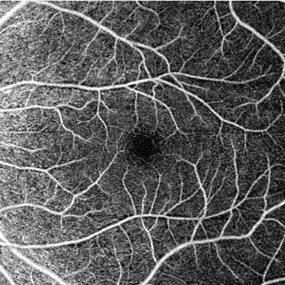 Close-up of a leaf's surface with prominent veins and a dark central hole.