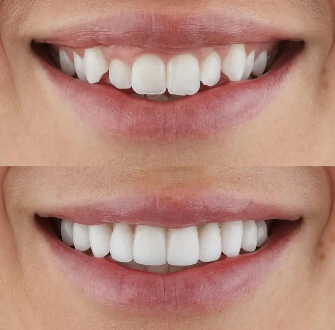 Gingivektomi + kompozit lamina, Dişlerde aşındırma yapılmadan yapılmıştır 🤩